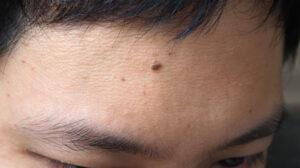 Nốt ruồi ở giữa trán rất dễ nhận diện với màu nâu hoặc đen, khiến gương mặt trở nên kém sắc