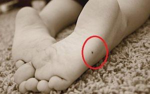 Nốt ruồi trên mép bàn chân thể hiện ý nghĩa không quá tốt